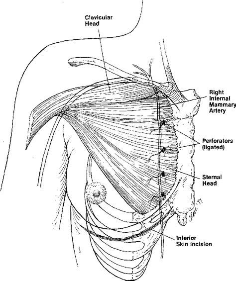 Does Pectoralis Major Myocutaneous Flap Cause the Shoulder。